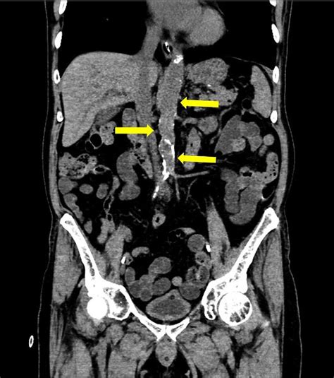 -Leriche syndrome: noncontrast CT coronal showing plaque within the ...