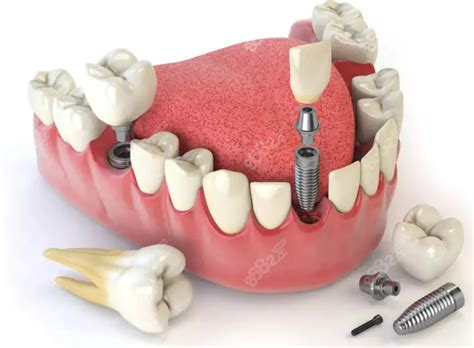种植牙多少钱一颗2023价格表发布，含单颗半口全口收费种植牙 8682赴韩整形网