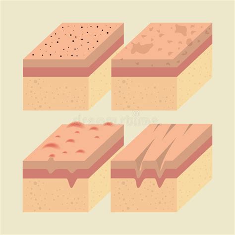 Skin Layers Stock Illustrations – 774 Skin Layers Stock Illustrations ...