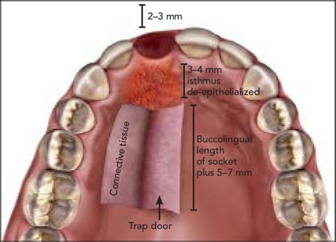 Following atraumatic extraction, the dimensions of the pedicle graft... | Download Scientific ...