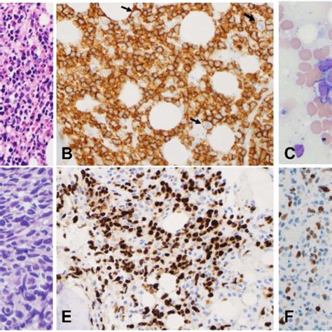 Bone Marrow Biopsy Case 1 The Initial Bone Marrow Biopsy Of Case 1 Download Scientific