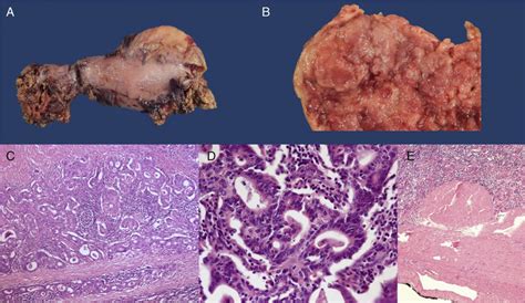 A) Surgical specimen from the total gastrectomy. B) View of the ...