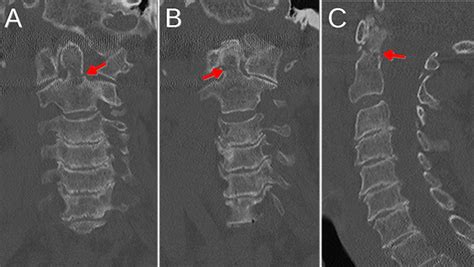 Odontoid Fracture