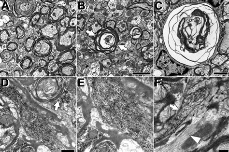 Ultrastructural Alterations Of Myelin And Axons Associated With