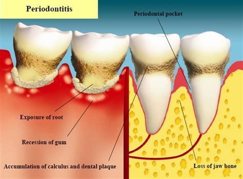 Periodontal Abscesses and Symptoms - Robert Madden