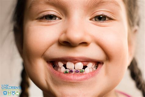 How Early Should Childrens Braces be Put on the Teeth?