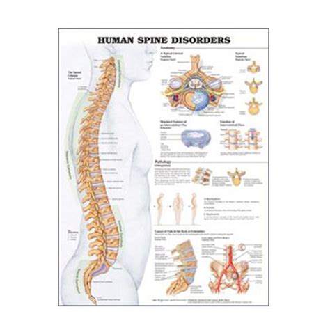 Anatomical Chart Co., Human Spine Disorders Chart (Laminated) - 1 Count