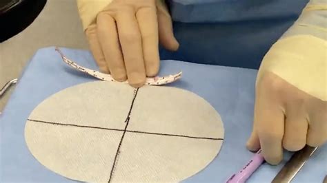 Robotic Sugarbaker Repair Of A Parastomal Hernia Utilizing Gore