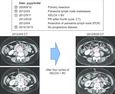 case 2 (#39): paraaortic lymph node metastases from rectal cancer in a... | Download Scientific ...