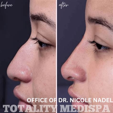 Liquid Rhinoplasty Archives Totality Medispa