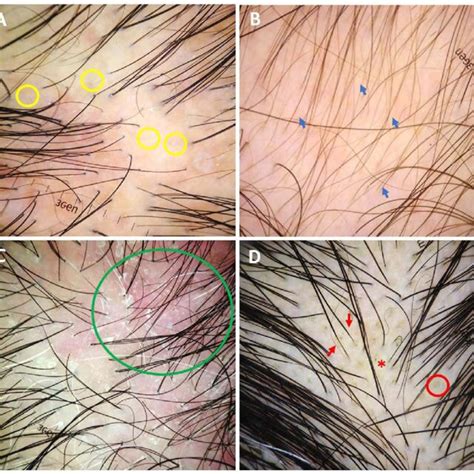 Trichoscopic features of alopecia areata (original magnification x20 ...