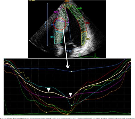 Figure 1 From Risk Stratification Using Myocardial Peak Longitudinal