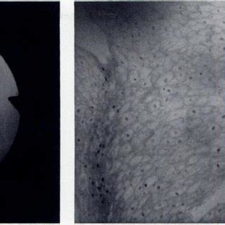 (PDF) Glycogenic acanthosis of the esophagus