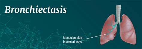 What Is Bronchiectasis? - Lung Institute