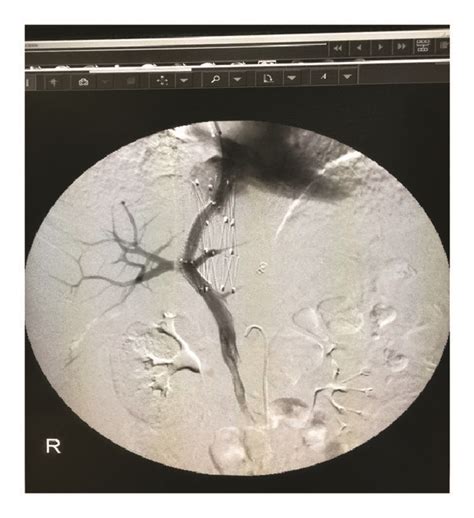 Dips Placement Combined With Ivc Stenting In Sos A Female Patient