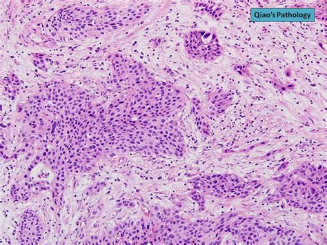 Qiao S Pathology High Grade Papillary Urothelial Carcinoma Of The