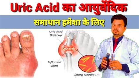 Uric Acid Permanent Ayurvedic Treatment In Hindi यूरिक एसिड का सम्पूर्ण समाधान Youtube