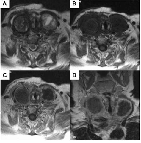 Magnetic Resonance Imaging Mri Of The Neck Prior To The Primary