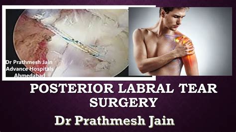 How Is A Posterior Bankart Repair Surgery Done Posterior Bankart And Glad Lesion With Loose Body