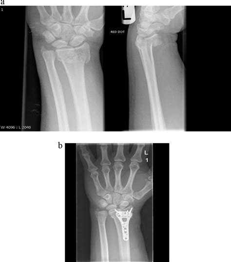 Intra Articular Distal Radius Fracture