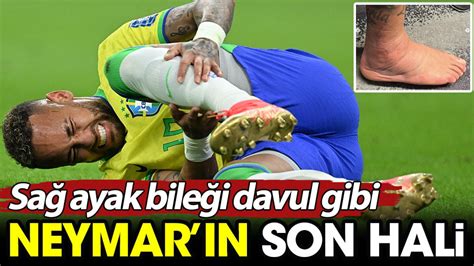 Neymar ın son hali Sağ bileği davul gibi şişti