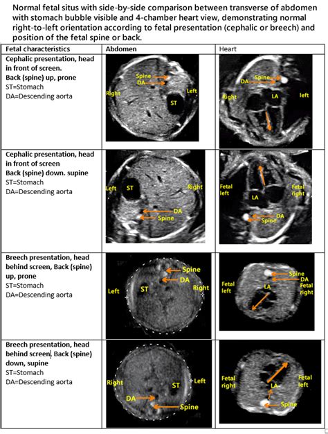 Normal fetal heart ultrasound – Artofit