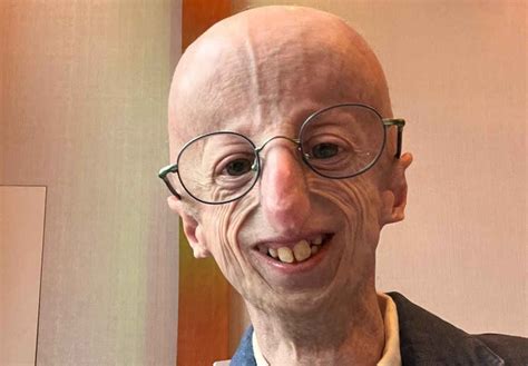 Sammy Basso era affetto da progeria ma cos è Di che malattia si