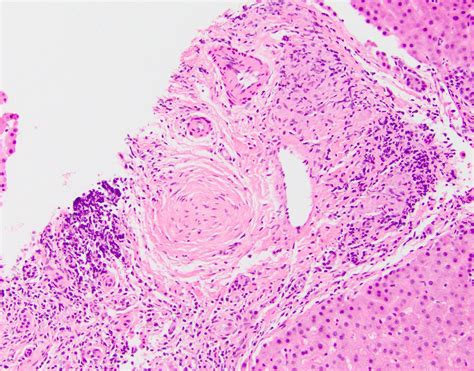 Primary Sclerosing Cholangitis Histology