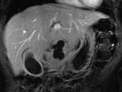 Mr Imaging Of Cystic Lesions Of The Pancreas Radiographics