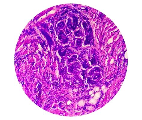 La Vista Microscópica Del Carcinoma Basocelular Es Un Tipo De Cáncer De