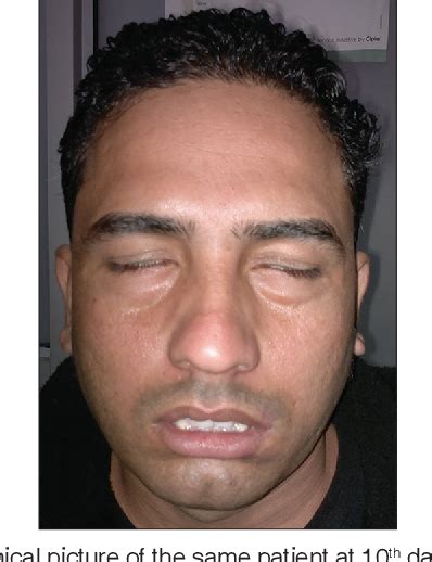 Bilateral Facial Nerve Palsy