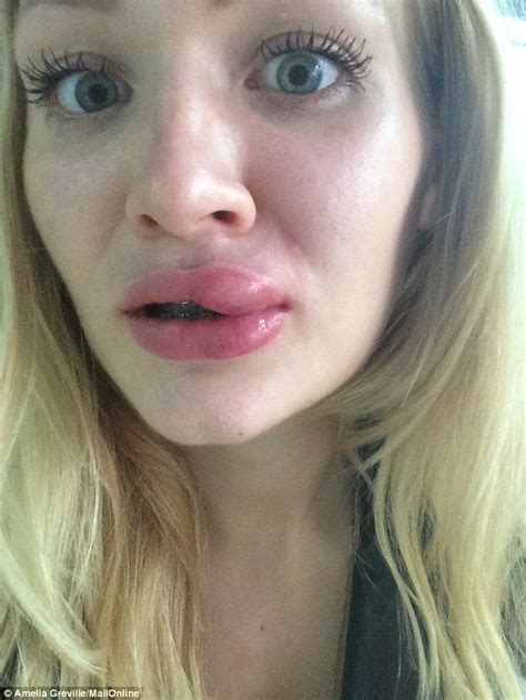 Sweet Pikin: Lip Fillers Gone Wrong For This Lady(Photos)