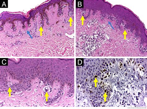 Dysplastic Nevus Histology