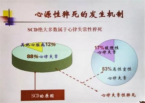 心源性猝死風險預測新進展 每日頭條