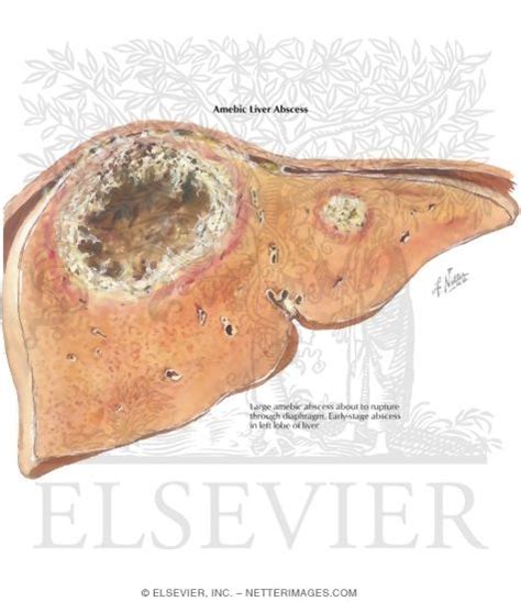 Amebic Liver Abscess