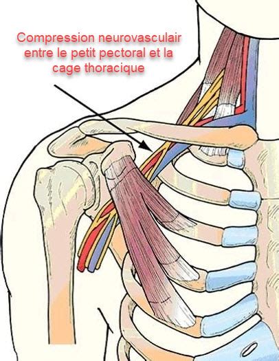 Pectoralis Minor Syndrome Osteomag