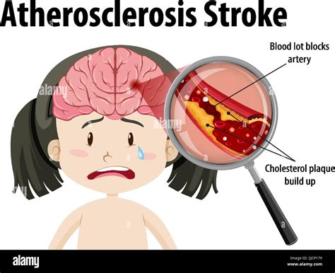 Human Anatomy With Atherosclerosis Stroke Illustration Stock Vector