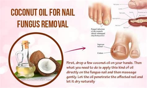 Top 16 Natural Home Remedies For Nail Fungus Removal