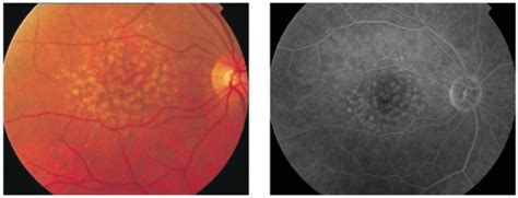 Fluorescein Angiography