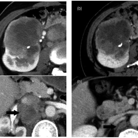 Ct Of The Primary Tumor And Hilar Lymph Nodes Before A And After B Download Scientific