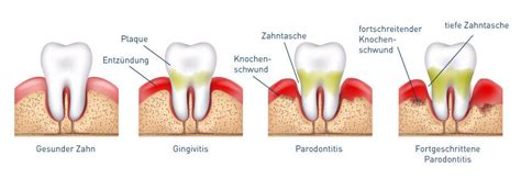 Parodontose Ursachen Symptome Behandlung