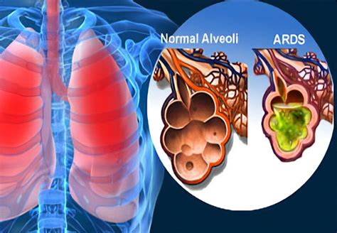 Acute Respiratory Distress Syndrome Causes And Management