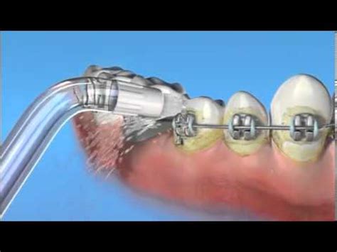 Ортодонтическая насадка OD-100E для ирригатора Waterpik - YouTube