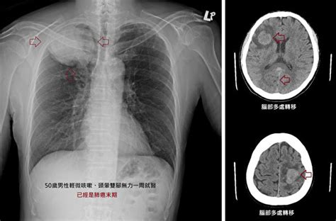 肺癌出现症状 常常已是末期 教你揪出早期肺癌 低剂量电脑断层 筛检 肺癌末期 大纪元