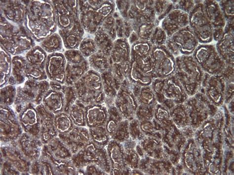 Pathology Outlines Epithelial Membrane Antigen Ema