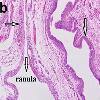 Ranula Histology