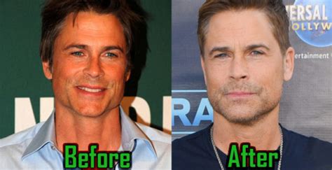 Rob Lowe Plastic Surgery Of Facelift Fillers Before And After