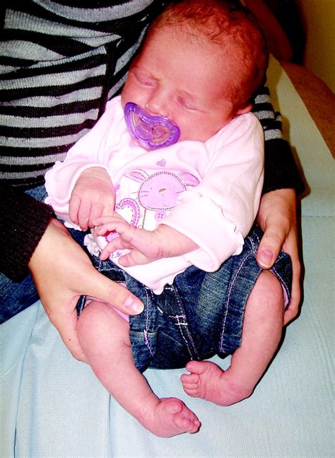 Current Management Of Clubfoot Congenital Talipes Equinovarus The Bmj