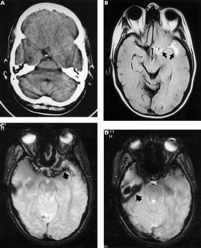 A Subtle Subacute SAH A Brain CT Was Done 7 Days After The