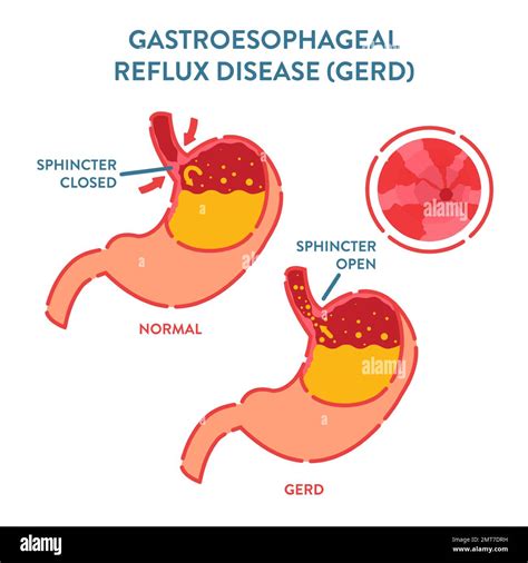 GERD stomach disease detected by endoscopy procedure Stock Vector Image & Art - Alamy